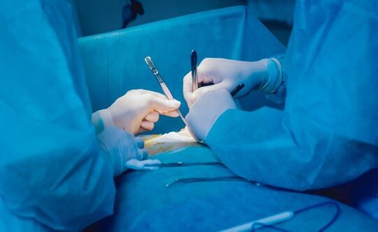 Εκτέλεση χειρουργικής επέμβασης διεύρυνσης πέους